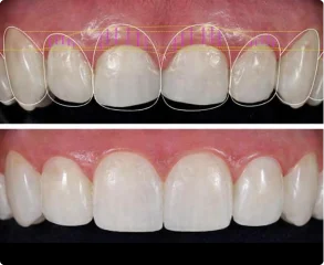 More Esthetic Crown Lengthening & Veneer Procedures