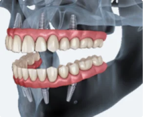 More All-on-X Implant Procedures