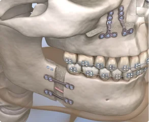 More Fee-For-Service Orthognathic Procedures